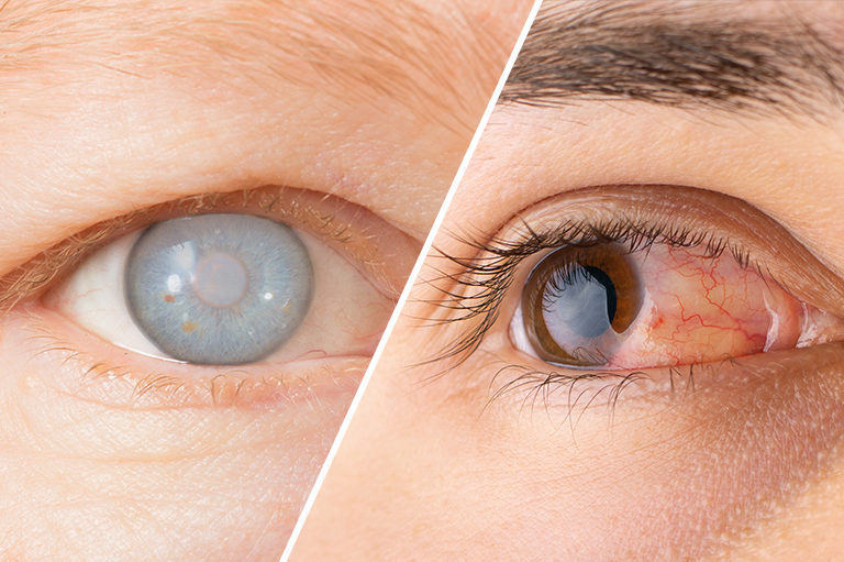 Eye Condition Comparison