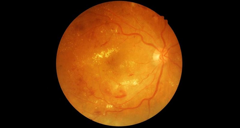 Diabetic Retinopathy