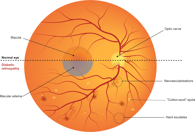 Eye Care Routine for Patients with Diabetes
