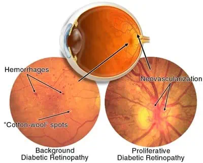 Diabetic Retinopathy in Howrah