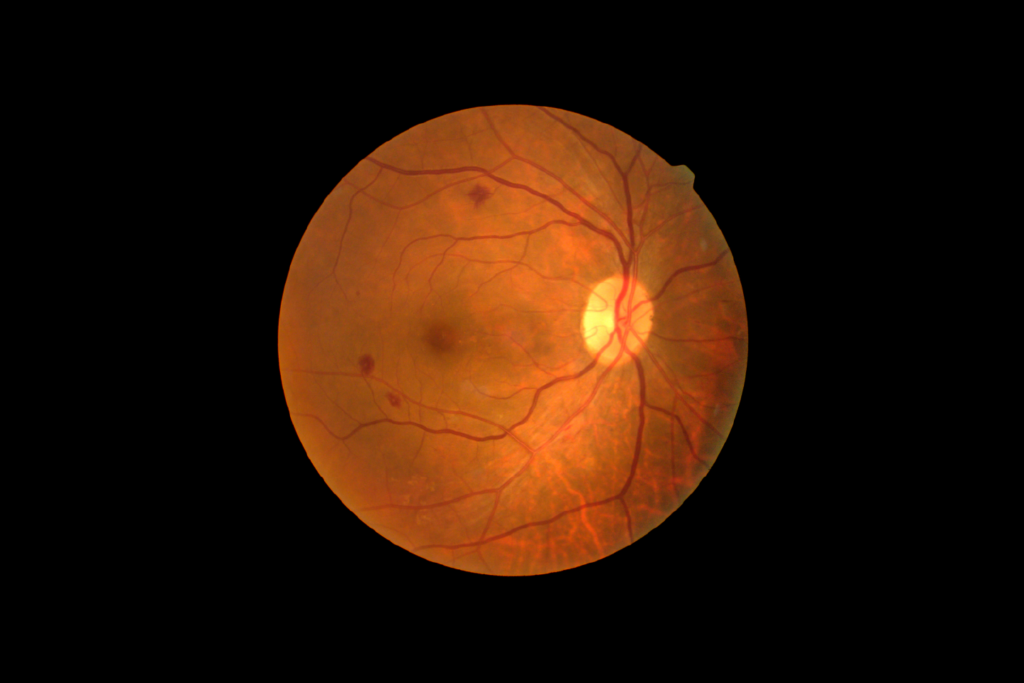 Diagnosing Silently Progressing: How to Identify and Treat Diabetic Retinopathy in Howrah and Beyond