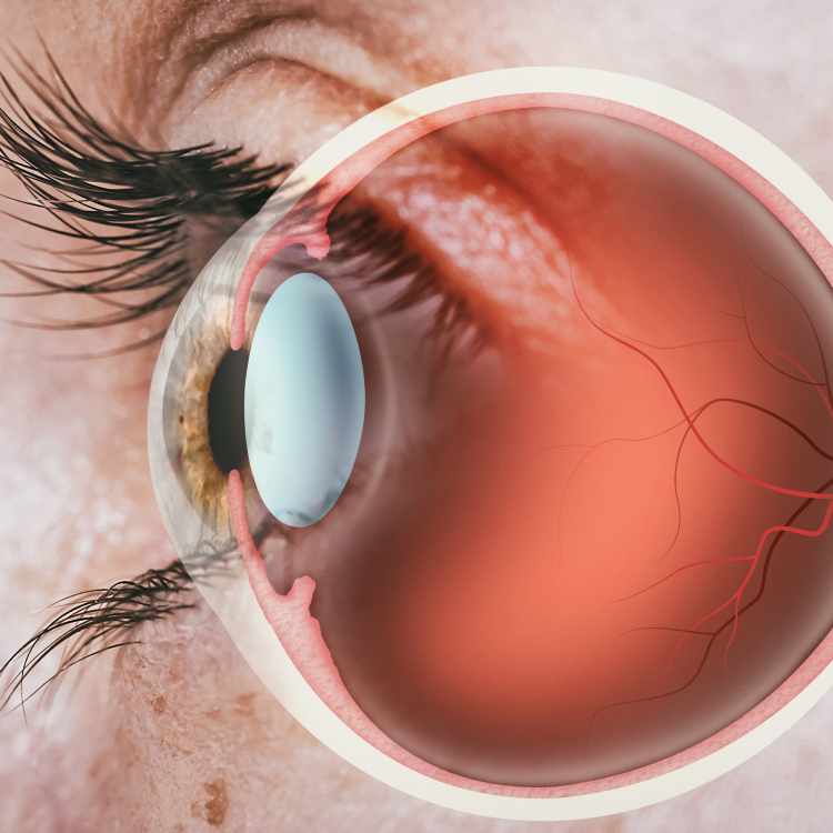 Cornea & Refractive Surgery - Image 1