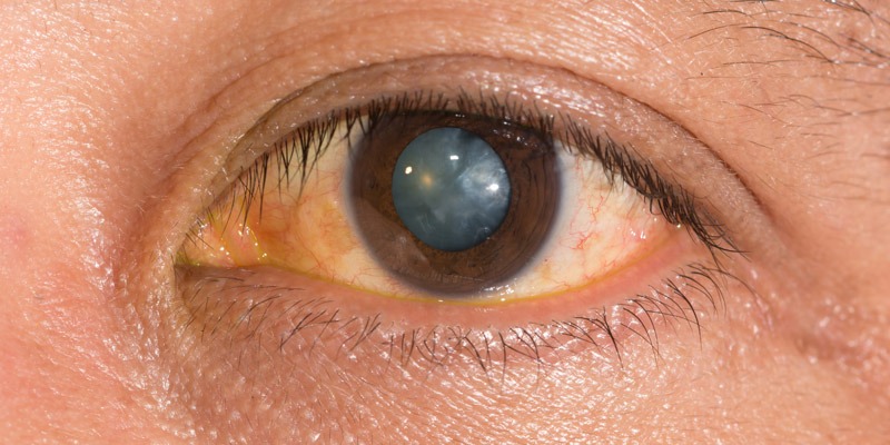 Cataract Treatment