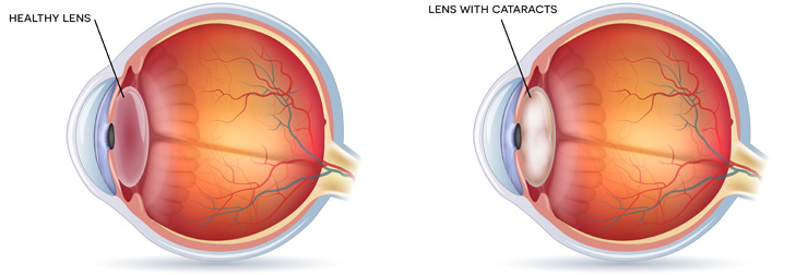 Cataract Treatment - Image 2