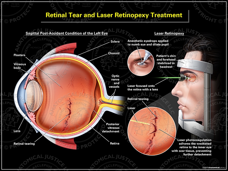 Diabetic Retinopathy Care