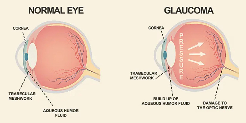 Glaucoma Management - Image 1