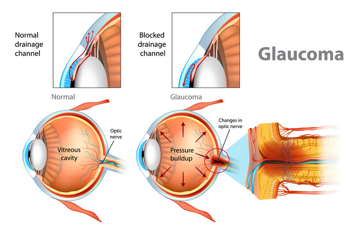 Glaucoma Management - Image 2