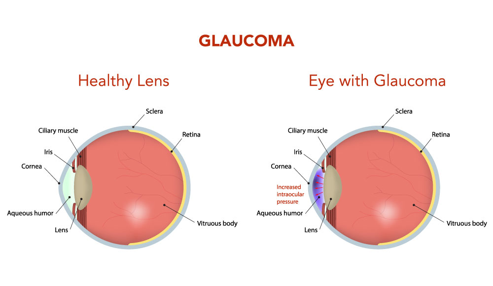 Glaucoma Management - Image 1