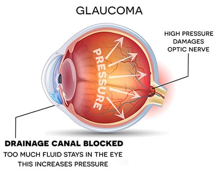 Glaucoma Management - Image 2